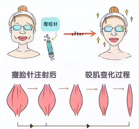 修容粉怎么用瘦脸针,修容粉怎么用瘦脸针修复.